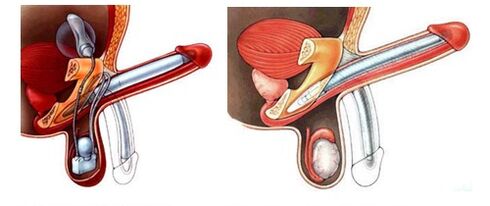 Penile prosthesis with an inflatable prosthesis (left) and plastic (right)
