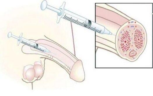 Hyaluronic acid injections satisfaction