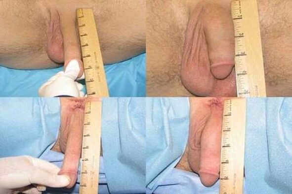 Measurement of the penis after enlargement surgery