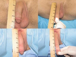 ligamentotomy before and after
