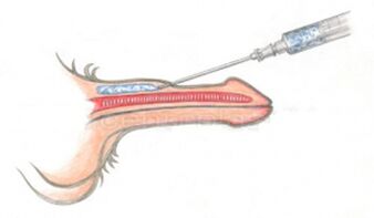 Volumetric injection of hyaluronic acid into the penis